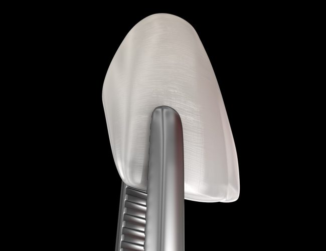 Veneer installation procedure over central incisor. Medically accurate tooth 3D illustration