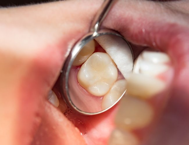 two chewing side teeth of the upper jaw after treatment of carie