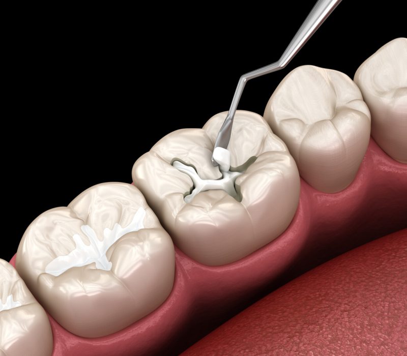 Decayed tooth restoration with composite filling. Dental 3D illustration