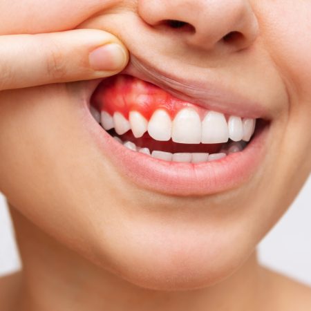 Gum inflammation. Cropped shot of a young woman showing bleeding gums isolated on a white background. Dentistry, dental care