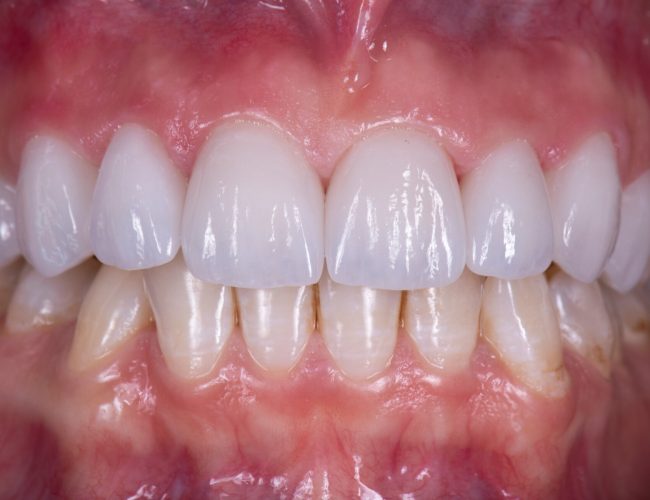 max crowns and veneers