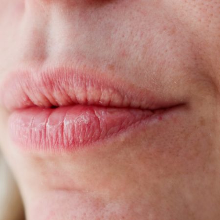 Close-up of woman's dry lips and skin with enlarged pores for cosmetic purposes