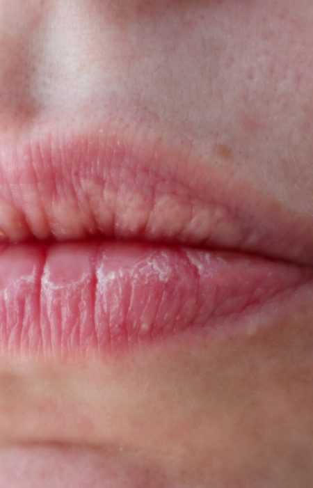 Close-up of woman's dry lips and skin with enlarged pores for cosmetic purposes