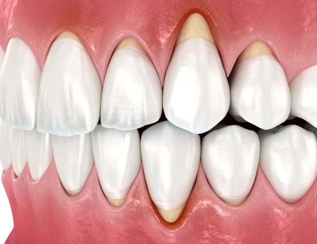 Gingiva recession. 3D illustration of dental disease