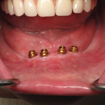 dental implants