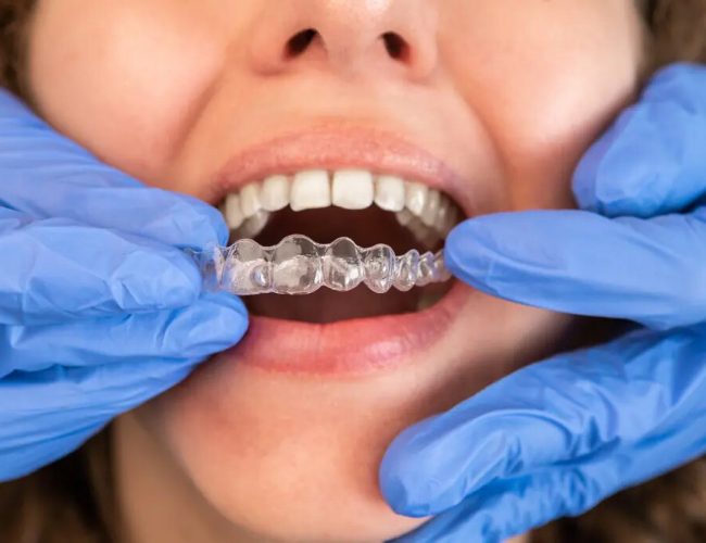 invisalign