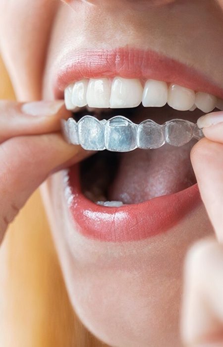 invisalign